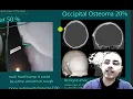 Hard non-painful bump on the back of the head Possible causes