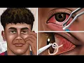 Download Lagu [ASMR] Treatment of pink eye, eye sebum extrusion | Remove eye worm animation