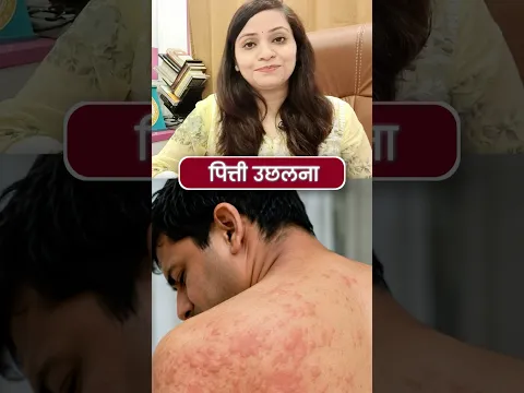 शरीर पर लाल चकत्ते और खुजली? Hives का Homeopathy इलाज! 🔴