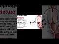 Download Lagu COMPLICATIONS of ACID REFLUX - Part 1 #gastroesophagealrefluxdisease #gerd #acidreflux #acidity #gut