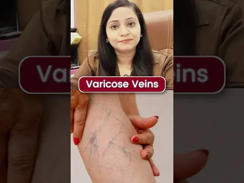 पैरों की नसें उभर आई हैं? Varicose Veins का Homeopathy इलाज! 🦵