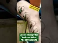 Download Lagu #Leech #Therapy for #Varicoseveins /Ph: 9891652572 #viral #jonk/ Dr. Aamir Atique Hijama / Leech