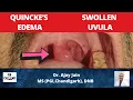 Swelling of uvula Quincke Edema Angioneurotic oedema Uvula Functions Causes Management