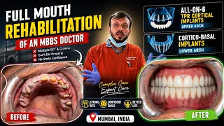 Full Mouth Rehabilitation of an MBBS Doctor | All-on-6 & Cortico-Basal Implants | Mumbai
