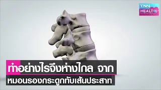  ถ้ามีอาการหมอนรองกระดูกกดทับเส้นประสาทควรพบแพทย์เมื่อใด 