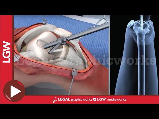 Intramedullary Nailing for Distal Femur Fracture Surgery 3D animation