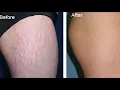 Stretch Marks Removal | How to Remove Stretch Marks Using Vicks Vaporub