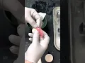 Little trick with thermoplastic beads for dentures