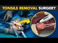 Download Lagu How Tonsillectomy Procedure Is Performed? | Tonsils Removal Surgery (Tonsillectomy)