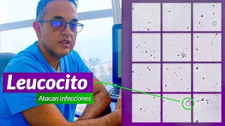 We cure azoospermia [Semen without sperm] male infertility: Seminogram or spermatobioscopy