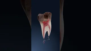 How Cavities Form A 3D Look At Tooth Decay Progression 