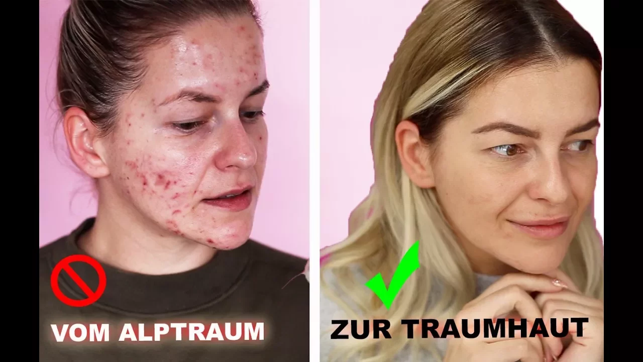 
          
          
          
            
            ❗️ In NUR 3 Monaten zur TRAUMHAUT   HEFTIGES Ergebnis ❗️ Microneedling Vorher Nachher/ Diana Delo
          
        . 