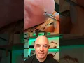 Download Lagu Doctor reacts to fat splinter removal! #dermreacts #doctorreacts #splinter #splinterremoval