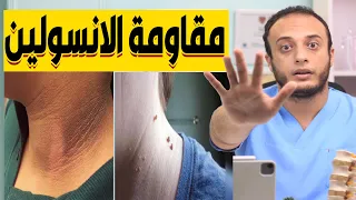 ١٠ أعراض خطيرة بتقولك انك داخل على سكر أو عندك مقاومة انسولين ومش واخد بالك