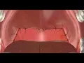 Modified UPPP for Sleep Apnea Treatment