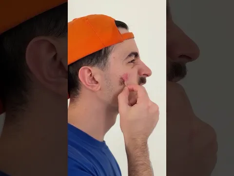 no te toques las costras de las heridas
