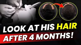 Hair Transplant After 4 Months: Patient Shares His Real Experience! | HairMD Clinic, Pune
