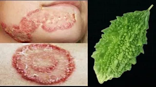 दाद खाज खुजली की 2 दिन में छुट्टी कर देगा Fungal Infection Treatment at Home / Daad Khaj Khujli