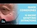 QUICK COMEDONES 10 Recent Satisfying Extractions