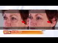 Plexaderm