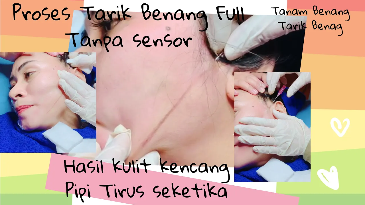 
          
          
          
            
            Proses Tarik Benang full Tanpa Sensor
          
        . 