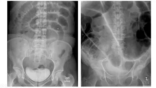 Welcome to Final Year Stomas and bowel obstruction