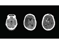 How to Read a CT Scan of the Head - MEDZCOOL