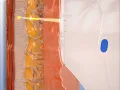 Ultherapy Uygulaması Ankara