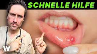 Aphthen: gefährlich oder harmlos?