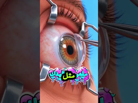 ماذا يحدث للقرنية أثناء عملية تصحيح النظر بالليزر؟#shortvideo