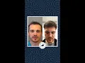 Hair Transplant - 8 Months Result