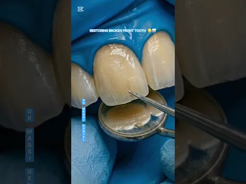 RESTORING BROKEN FRONT TOOTH ⚒️🦷