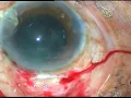 Download Lagu Best video for Teaching manual SICS to the beginners of Cataract Surgery