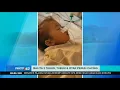 Download Lagu Raya, Balita di Sukabumi Meninggal dengan Tubuh Dipenuhi Cacing Gelang