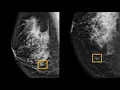 AI model improves breast cancer detection on mammograms