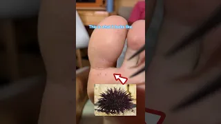 Stepping on a sea urchin 🥴 #sailboat #firstaid #sailingfamily #travel #ocean #sealife #ocean #boat