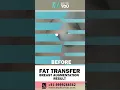 Breast Augmentation with Fat Grafting Fat Transfer Breast Enlargement Results Dr PK Talwar