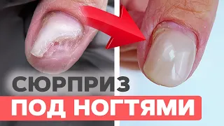 Сложная ногтевая пластина: зачистка и протезирование