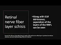 Schisis of Retinal Nerve Fiber Layer and ILM Dehiscence