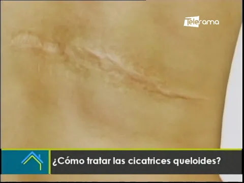 ¿Cómo tratar las cicatrices queloides?