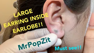 Download Giant earring completely hidden inside earlobe.Foreign body pop,Metal extraction.Must see to believe MP3