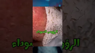 افضل وصفة لازالة الرؤوس السوداء 