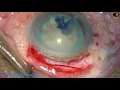 Download Lagu SICS for first \u0026 second year Ophthalmology Residents : Pradip Mohanta, 10/4/2019