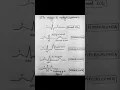 Download Lagu ECG changes