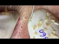 Loan Nguyen Acne Treatment 360pre