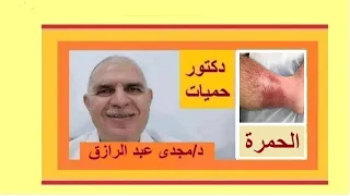 علاج الحمرة و الألتهاب الخلوى بالساق بودكاست 