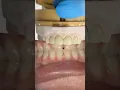 Download Lagu Monet Pure Zirconia Incisors #lsk121shorts #dentist #teeth