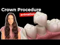 Download Lagu Dental Crown Procedure at the Dentist
