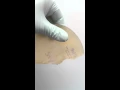 Gummy Bear Breast Implants Do Not Leak or Rupture