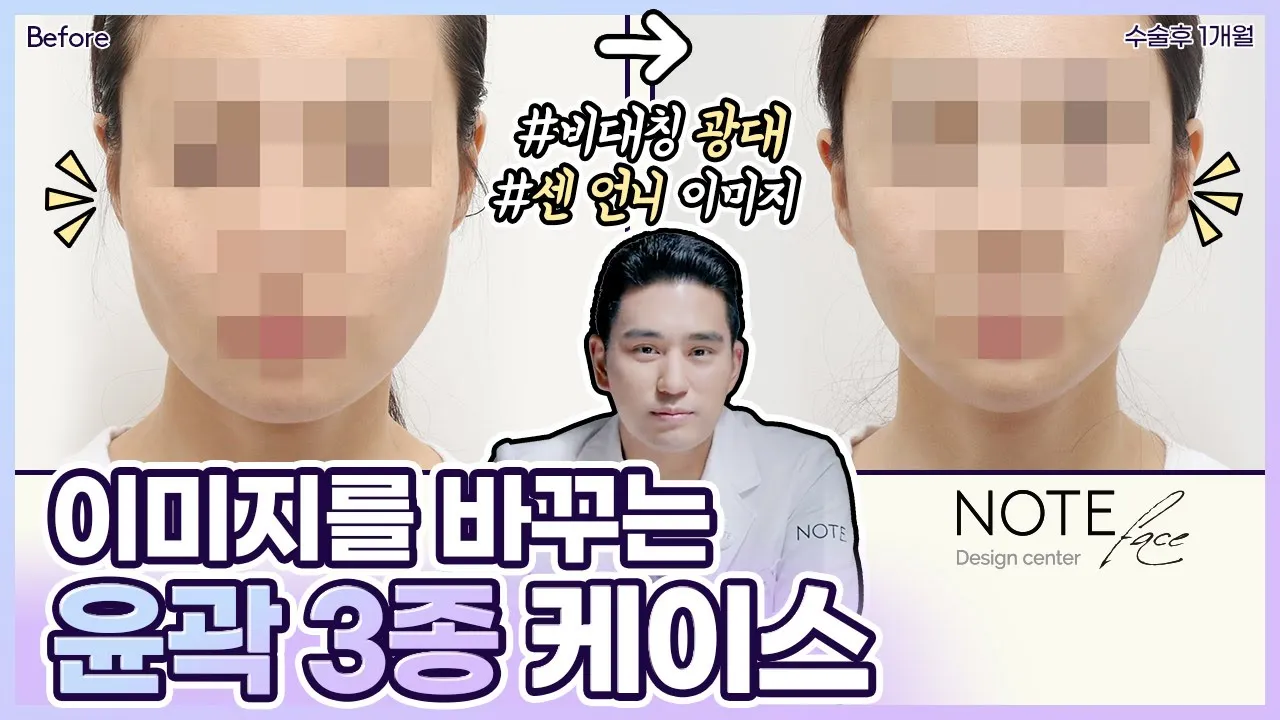 [유.케.리] 📍 CT로 보는 케이스 리뷰 l 광대축소+턱끝ㅅ절골 전진 +긴곡선 사각턱 l